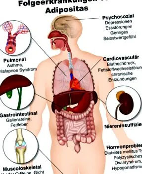 supraponderabilitatea osteoartritei