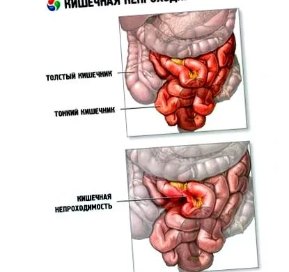 intestinului