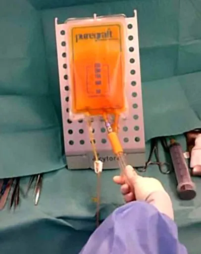 lipofilling