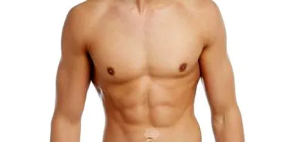 gynecomastia