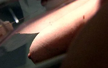 mastectomia