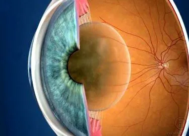cataractei
