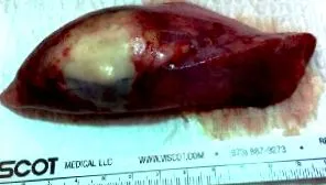 hemoptysis