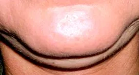 lipoliza