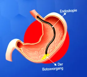 gyomor botoxot