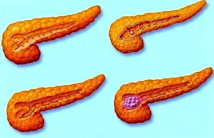 tumora