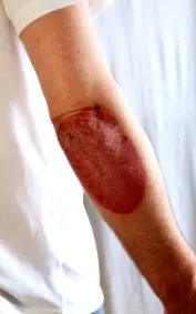psoriazisul