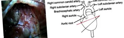 aorta gyökér