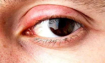 vállfájdalom