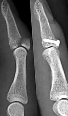 tendoanelor extensoare