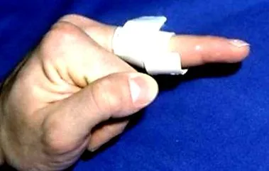 leziuni extensoare