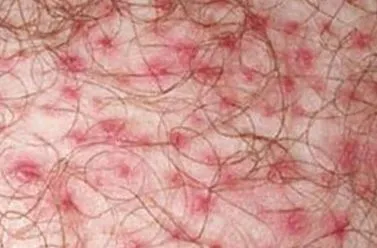 ureaplasma
