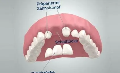 dentare