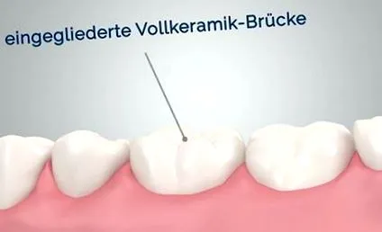 dentare