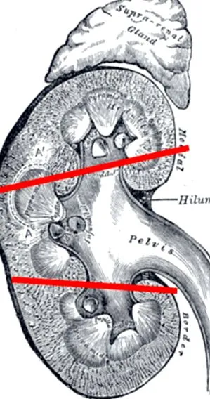 nefrectomie