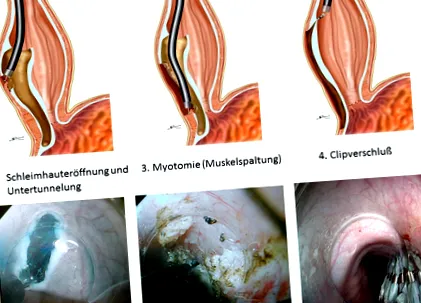 achalasia