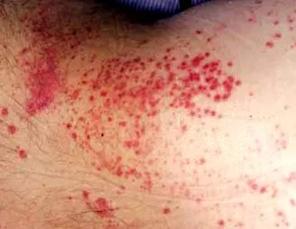 antibiotic