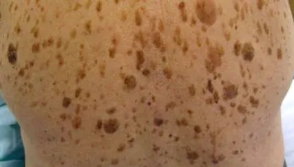 keratoză