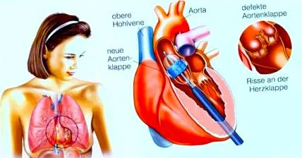 aortică