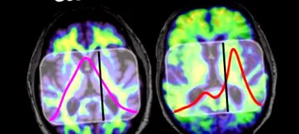 sânge alzheimer