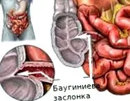 баугинит