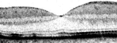 szerosus