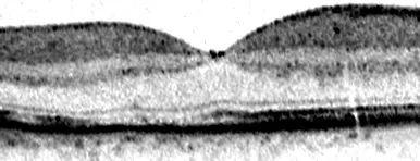 makula