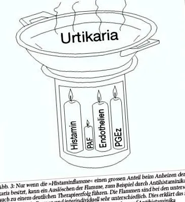 urticaria diagnostic