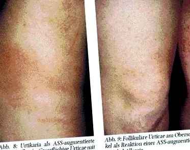 standarde urticaria