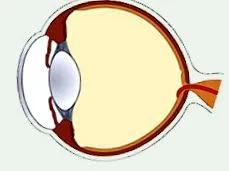 retinopátia