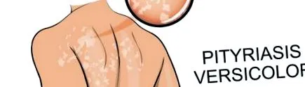 pityriasis