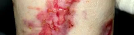 epidermolysis bullosa