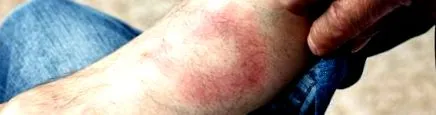 erythema