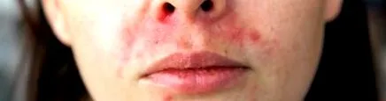 perioralis