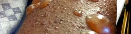 pemphigus vulgaris