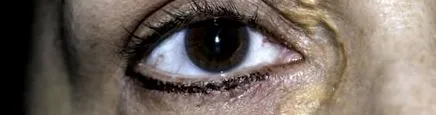 xanthelasma