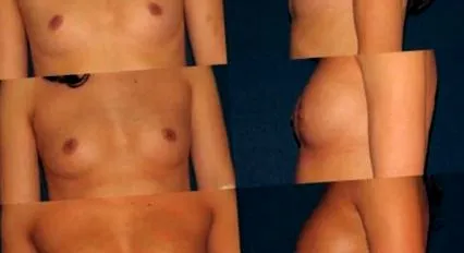 lipoclinic mellnagyobbítás