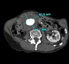 aorta
