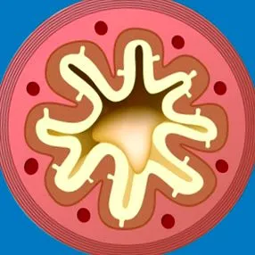 bronchitis