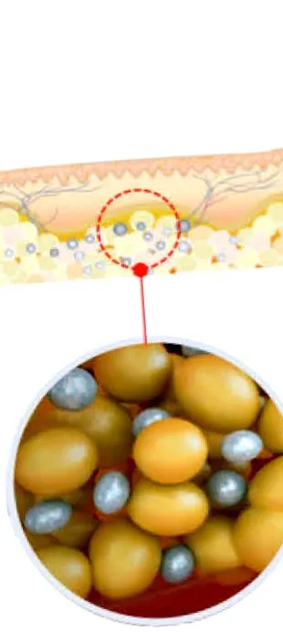 kryolipolysis
