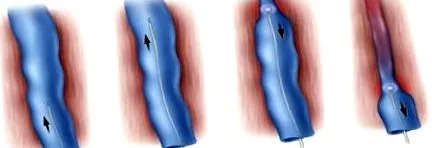diagnosticul varicoase