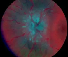 pseudotumor