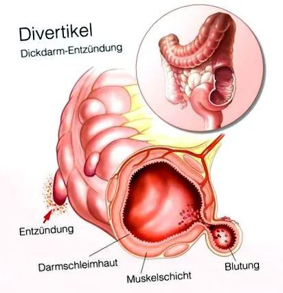 diverticulum