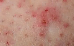 hiperkeratoza boala