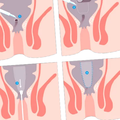 fistula