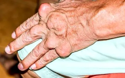 osteoartrita