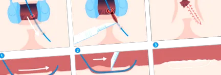 fistula
