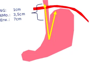 reflux