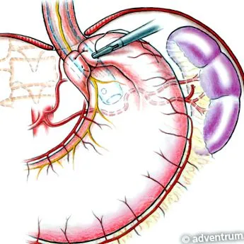 fundoplication