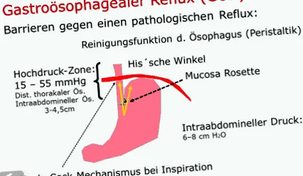 gastroesophagealis